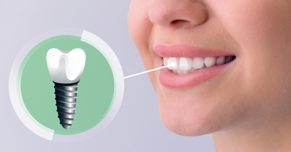 Restoring Confidence Through Advanced Tooth Replacement Techniques